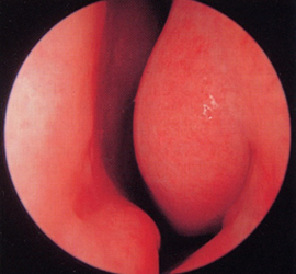 アレルギー性鼻炎