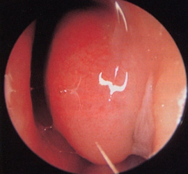 アレルギー性鼻炎