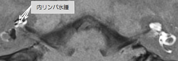 図3 内リンパ水腫