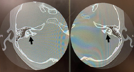 小児難聴で頻度の高い内耳奇形（前庭水管拡大症）の例