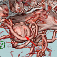 造影三次元CT画像