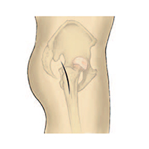 すり減った大腿骨頭の軟骨