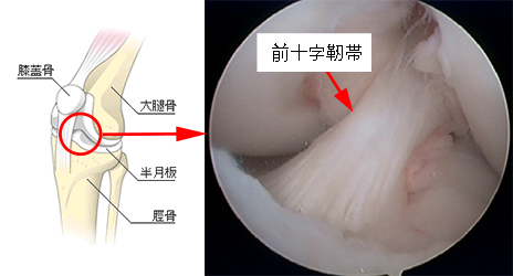 すり減った大腿骨頭の軟骨