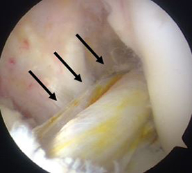 再建された前十字靭帯（黒矢印）