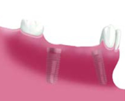 インプラント埋入手術