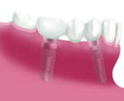 人口歯の取り付け